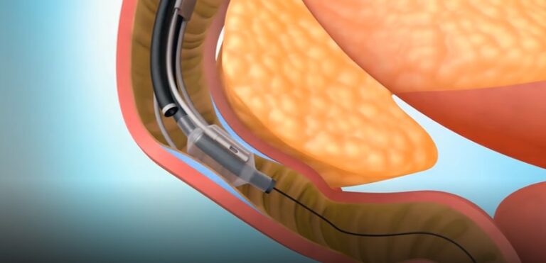 In A First-in-the-Nation Procedure, AdventHealth Tests Promising New Diabetes Therapy