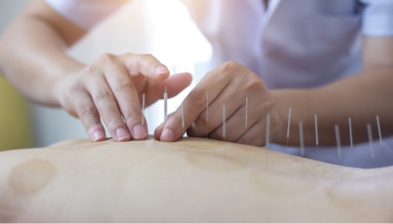 Common Questions About How Acupuncture Works