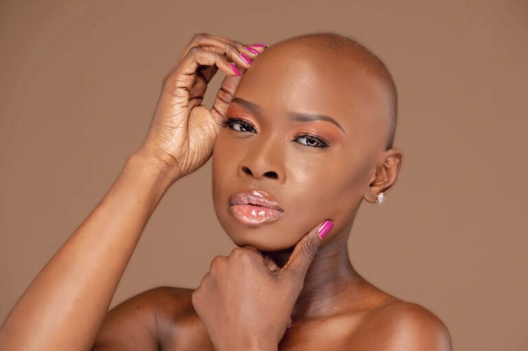 Strength and Beauty While Living with Alopecia Areata