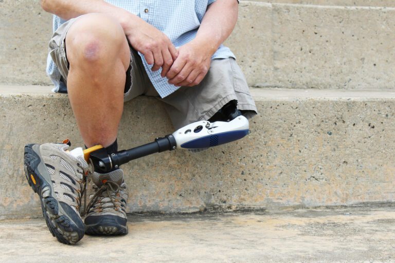 Limb Loss Occurs Every Three Minutes Because of this Debilitating Condition