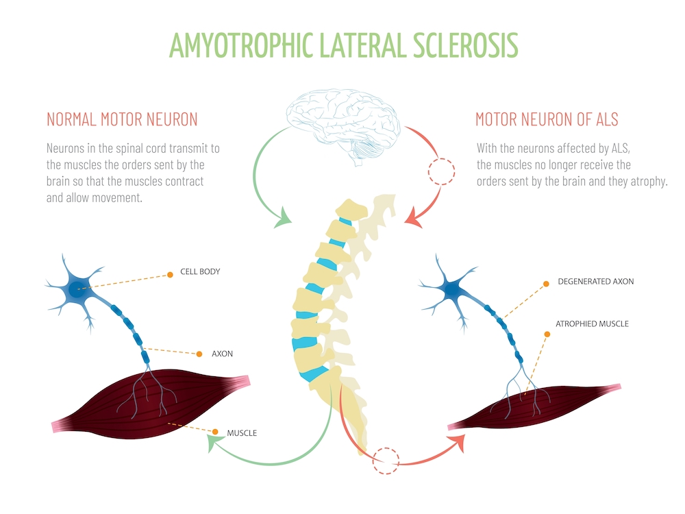 Infographic about the functioning of the orders from the brain to the muscles with and without amyotrophic lateral sclerosis.